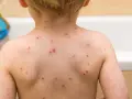 Plecy dziecka pokryte licznymi czerwonymi krostkami, które mogą świadczyć o tym, czy odra swędzi.