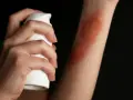 Dłoń aplikuje spray na rękę z widocznymi bliznami po oparzeniu 2 stopnia.