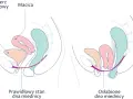 Porównanie prawidłowego i osłabionego dna miednicy. Po porodzie macica może ulec opadnięciu.