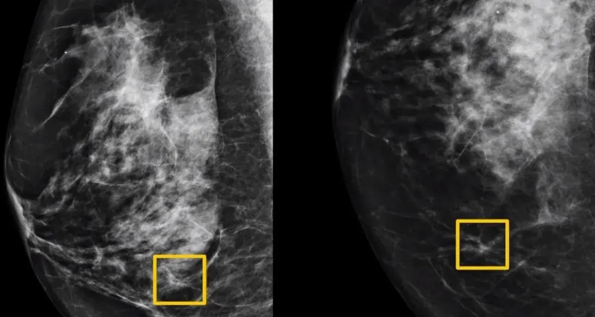 Mammografia pokazuje, jak wygląda rak: nieregularne, poszarpane cienie w tkance piersi, zaznaczone żółtymi ramkami.