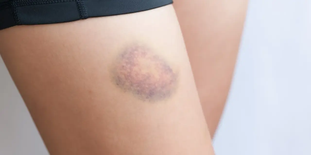 Siniak na udzie, który można smarować maścią na siniaki.