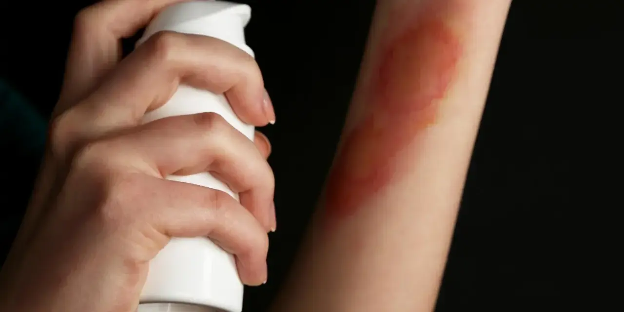 Dłoń aplikuje spray na rękę z widocznymi bliznami po oparzeniu 2 stopnia.