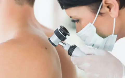 Lekarz w masce i rękawiczkach bada pieprzyk dermatoskopem. To właśnie dermatoskopia co to jest, czyli badanie skóry pod powiększeniem.
