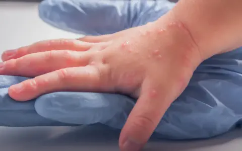 Dziecięca dłoń z licznymi pęcherzykami, widoczna wysypka u dziecka na niebieskiej rękawiczce.