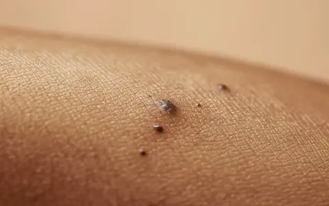 Zbliżenie na skórę z kilkoma ciemnymi znamionami, jedno z nich ma nieregularny kształt i połyskujące refleksy, co może być jednym z objawów czerniaka skóry.