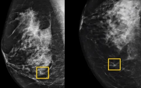 Mammografia pokazuje, jak wygląda rak: nieregularne, poszarpane cienie w tkance piersi, zaznaczone żółtymi ramkami.