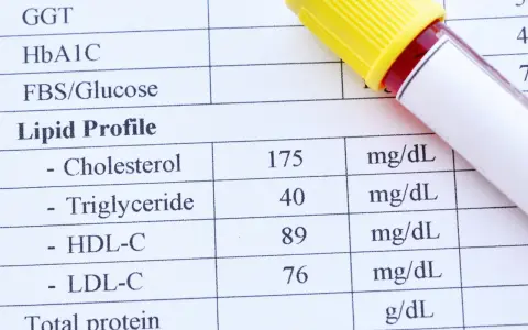 Wyniki badań lipidogram: cholesterol, trójglicerydy, HDL-C, LDL-C. Obok probówka z krwią.