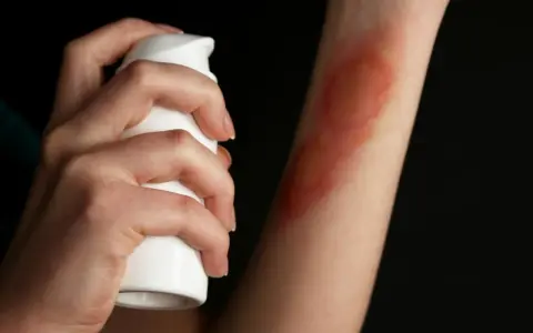 Dłoń aplikuje spray na rękę z widocznymi bliznami po oparzeniu 2 stopnia.