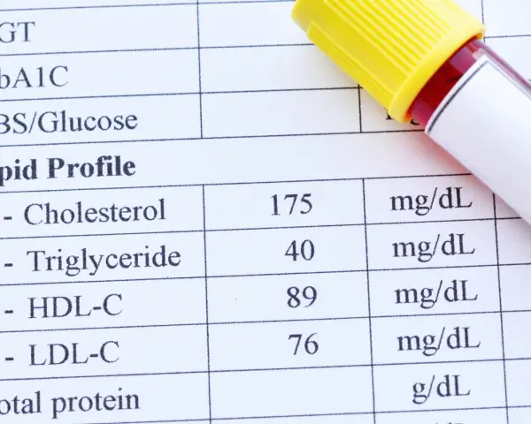 Wyniki badań lipidogram: cholesterol, trójglicerydy, HDL-C, LDL-C. Obok probówka z krwią.