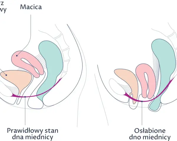 Porównanie prawidłowego i osłabionego dna miednicy. Po porodzie macica może ulec opadnięciu.