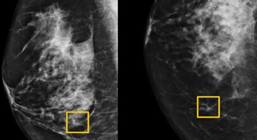 Mammografia pokazuje, jak wygląda rak: nieregularne, poszarpane cienie w tkance piersi, zaznaczone żółtymi ramkami.