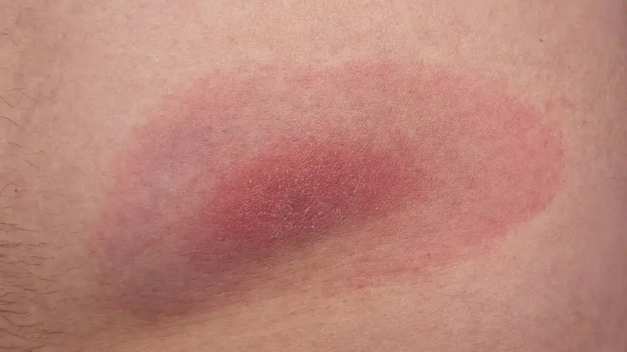 Obrzęk i zaczerwienienie skóry, które może pojawić się po ugryzieniu kleszcza. Miejsce po kleszczu jest wyraźnie widoczne.
