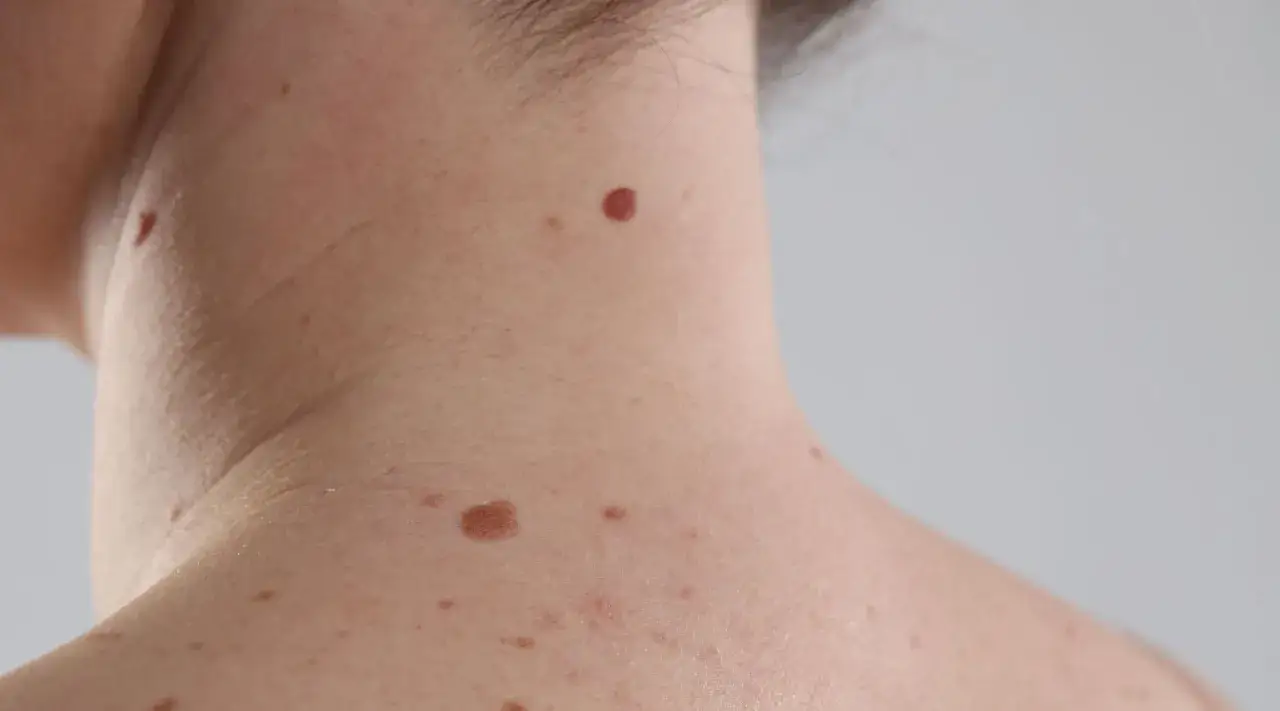Dermatolog bada pieprzyki na szyi pacjenta, oceniając ich stan.