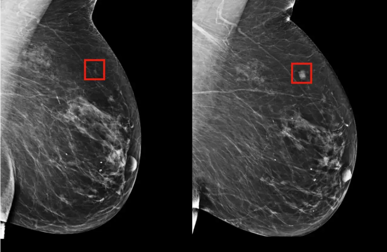 Dwie mammografie pokazują, jak wygląda rak na mammografii. Czerwone ramki zaznaczają podejrzane zmiany.