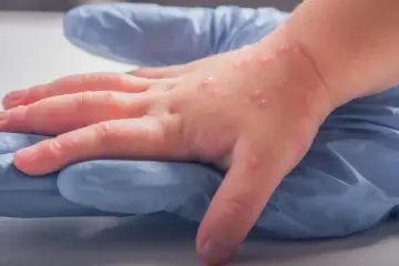 Dziecięca dłoń z licznymi pęcherzykami, widoczna wysypka u dziecka na niebieskiej rękawiczce.