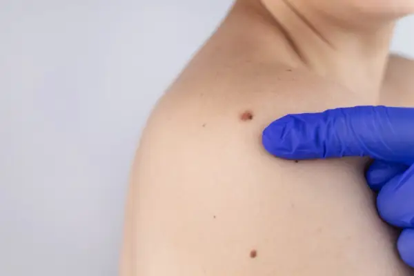 Niebieska rękawiczka wskazuje na pieprzyk na wewnętrznej stronie dłoni.